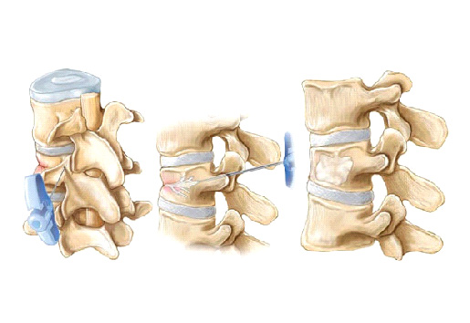 Удаление межпозвоночной грыжи цена нижний новгород thumbnail